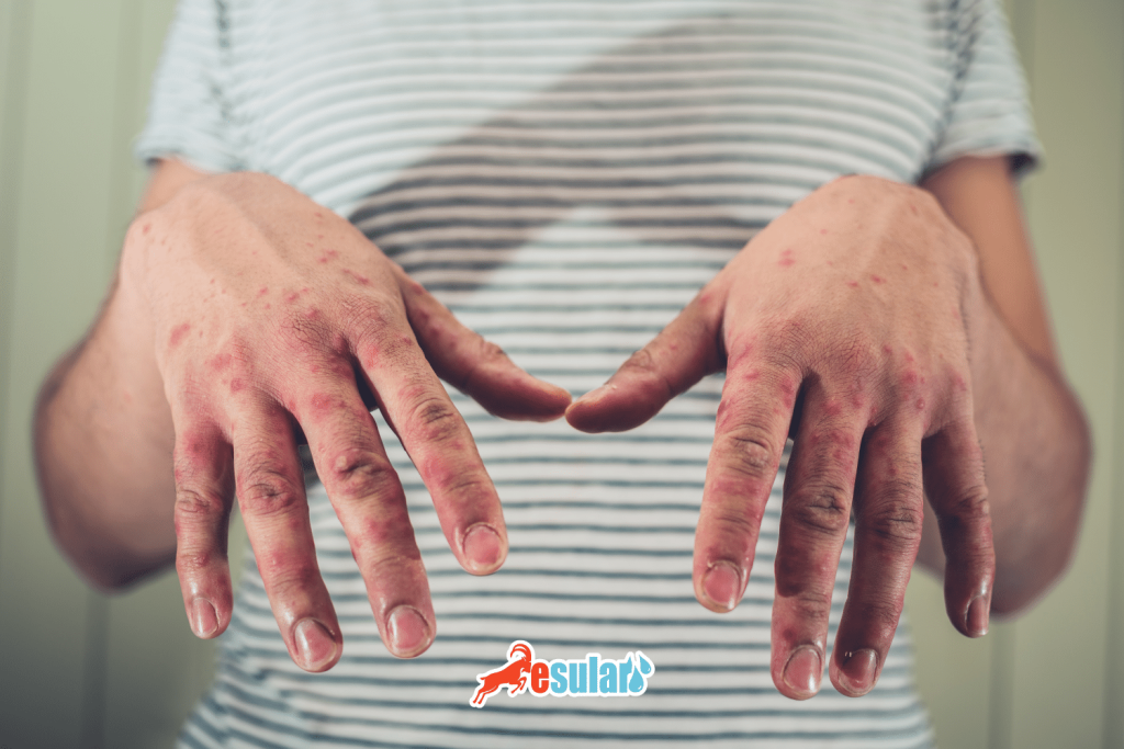 sap-hastaligi-bulasma-yollari